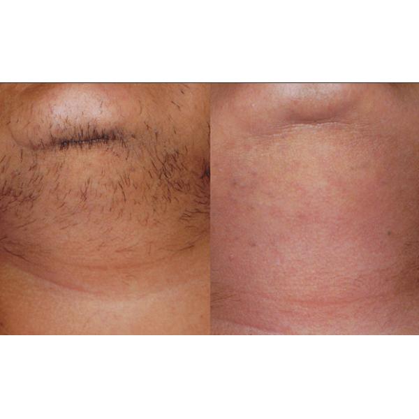 US Military Laser Bar Portable Laser Hair Removal Machines For Home Use