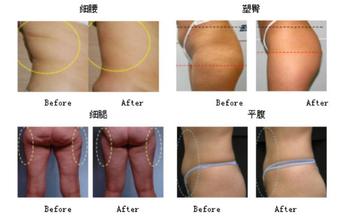 Non - Anaesthetic Ultrasonic Cavitation Slimming Machine Vacuum Body Shaping Equipment