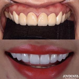 China CAD/CAM Compatible Zirconia Dental Crowns Precision Manufacturing For Tailored Shades And Sizes on sale