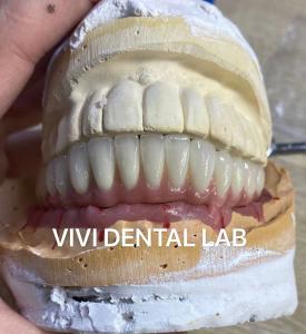 China Dental Implant Metal Ceramic Bridge On Titanium Abutments on sale