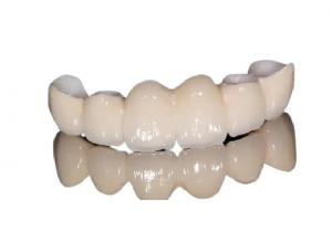 China Corrosion Resistant Porcelain Dental Crown Natural Appearance For Front Teeth / Back Teeth on sale