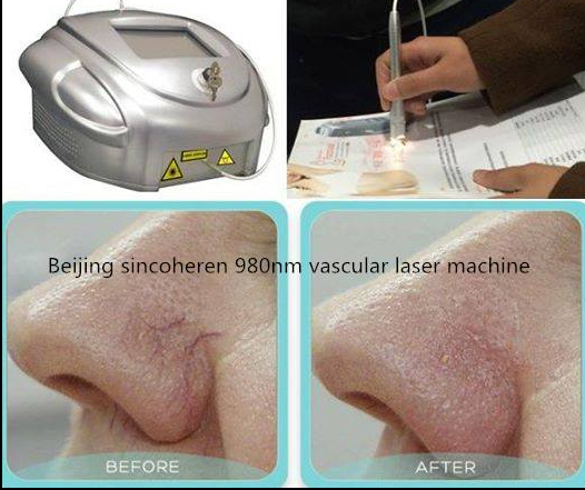2018 Distributor wanted 980nm laser machine fast effect vein removal vascular removal machine