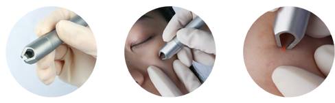 2018 Distributor wanted 980nm laser machine fast effect vein removal vascular removal machine