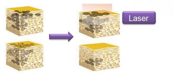 Hot selling q switch nd yag laser tattoo removal system tattoo machine