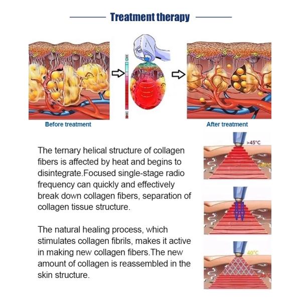 DS-35 Ultrasonic Radio Frequency Machines 300W Body Slimming Body Shaping