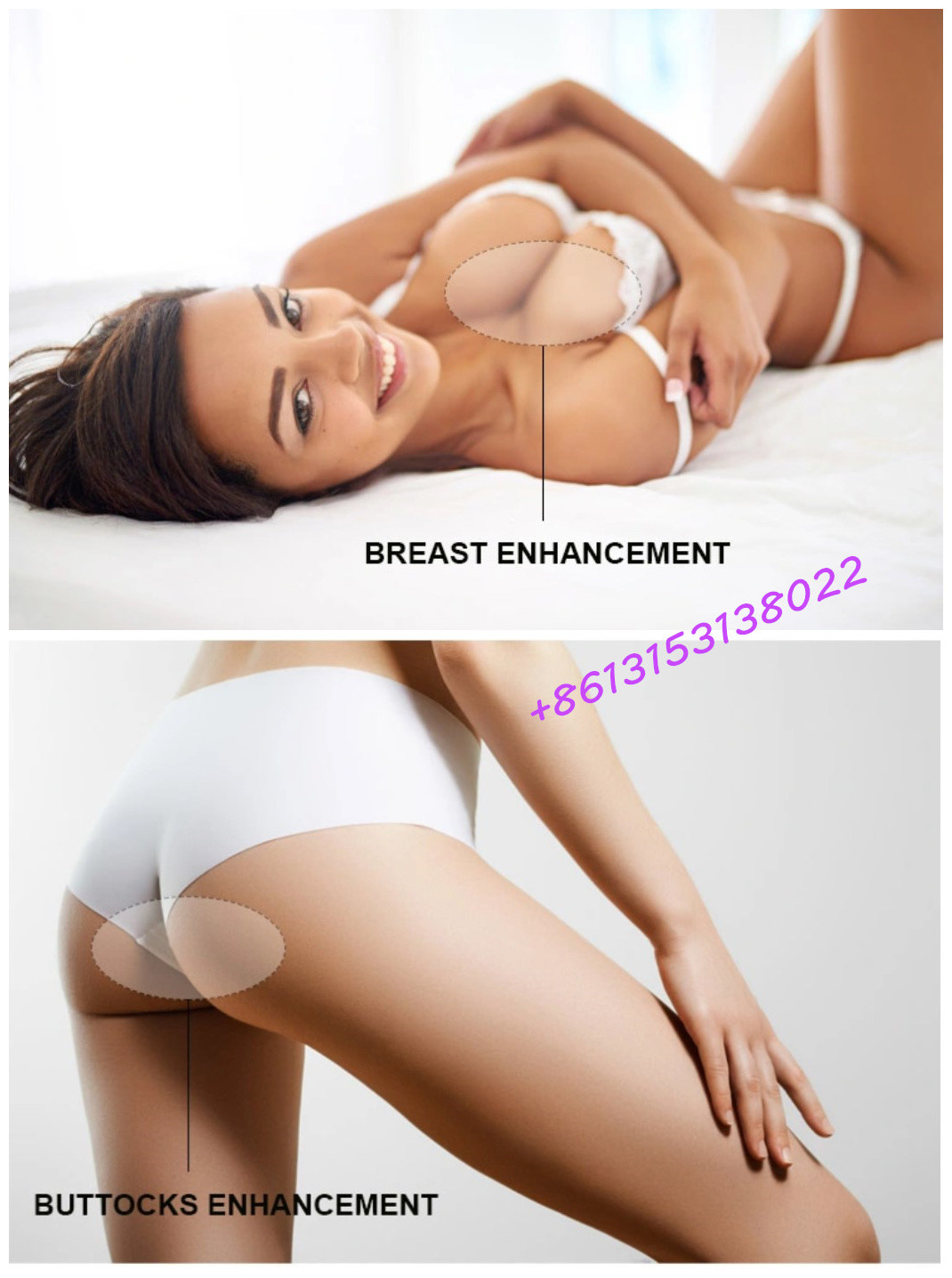 Cross Linked Hyaluronic Acid Dermal Filler For Buttock Enhancement