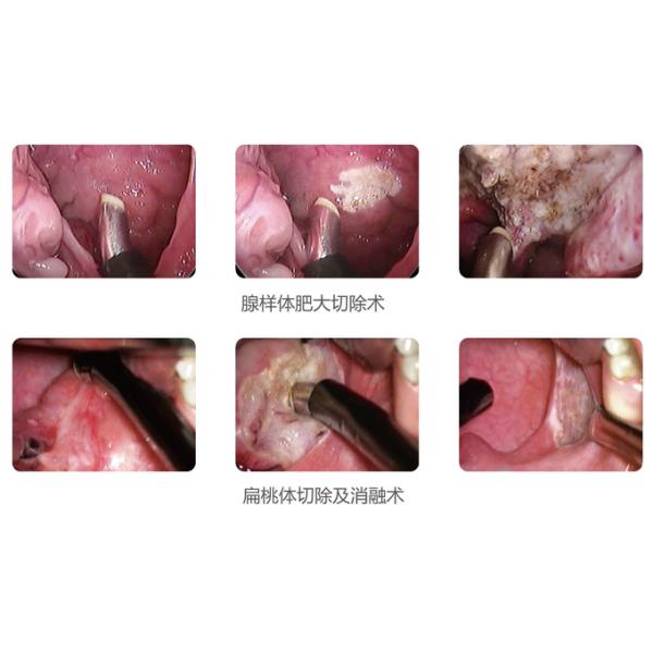 Cryogenic Radio Frequency Plasma Surgery System Minimal Invasive