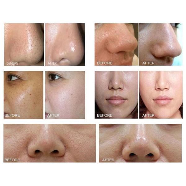 Ice Hammer Face Lift Blackhead Removal Hydro Facial Machines