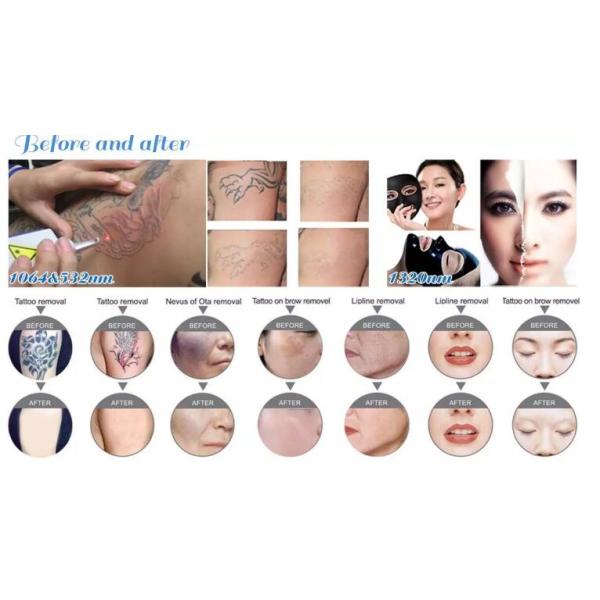 Portable Q Switch ND Yag Laser Machine 1500W With 8.4 Touch Screen