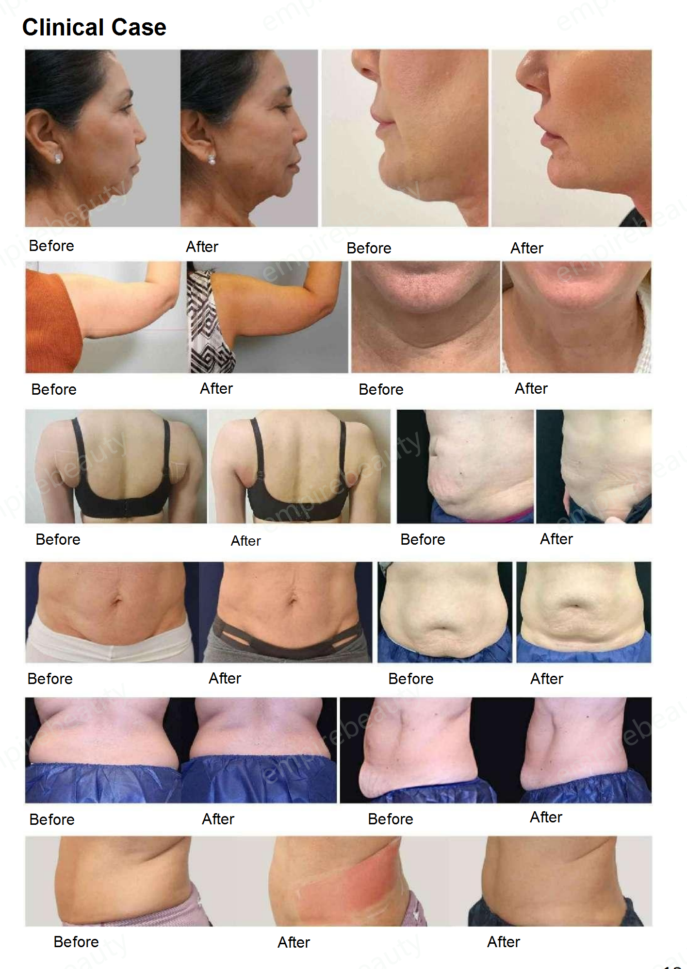 10 - 800W Body Slimming Machine 2MHz Fat Reduction Machine Portable