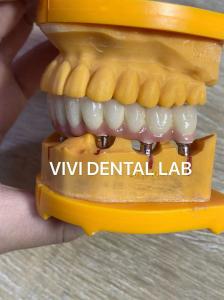 China Full Jaw Dental Implant Crown Metal Printed Digital Tooth Supported Bridge on sale