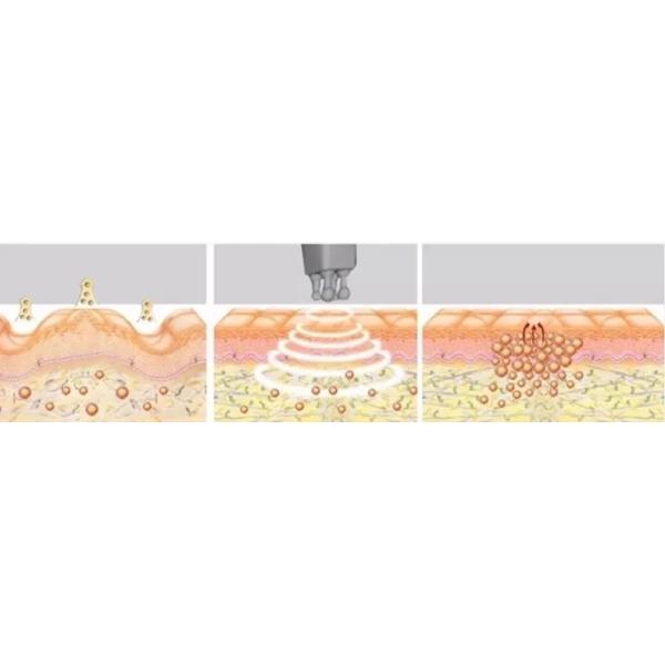 4 In 1 Cavitation Vacuum RF Ultrasonic Slimming Cellulite Remover