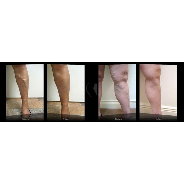 CW Mode EVLT Laser Machine 980nm Varicose Vein Treatment Devices