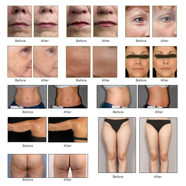 2 In1 Radar CARVING 4D Vmax Face Lifting Facial Body Tightening Machine