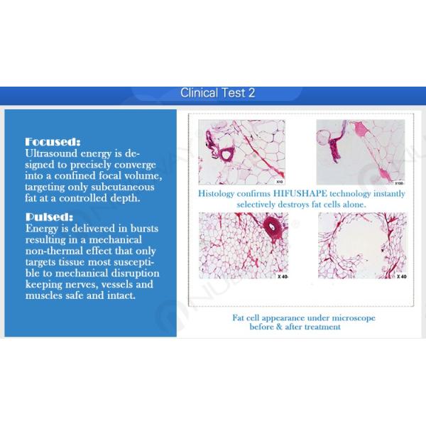 CE FDA approved boday slimming machine Non-surgical liposonix hifu ultrasound for body slimming machine