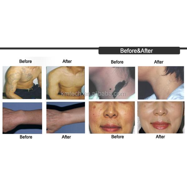 Portable Q Switch ND Yag Laser Machine 1500W With 8.4 Touch Screen