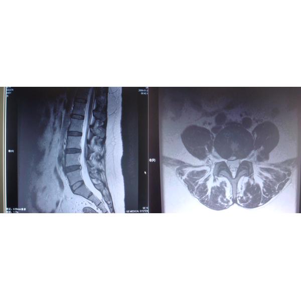 medical Sciatica 90% Back Decompression Machine