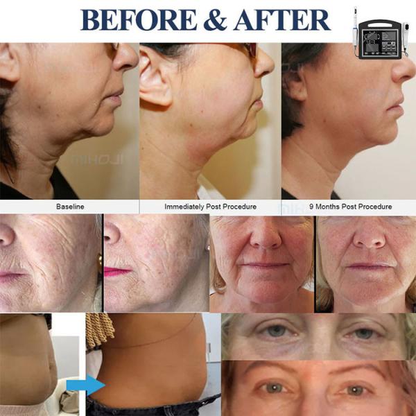 12 Lines Hifu 4d Machine Scar Removal High Intensity Focused Ultrasound Machine