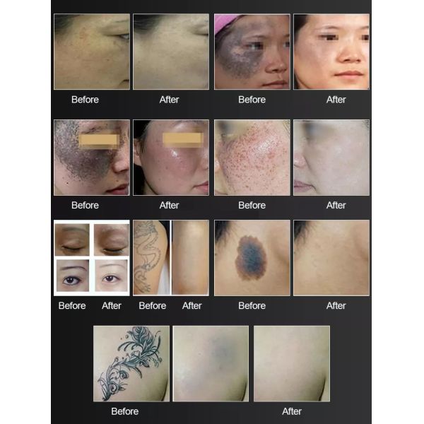 DPL Top-Ranked Product Picosecond Laser Q Switch ND Yag Laser Tattoo Removal Carbon Peeling Skin Rejuvenation Pico laser Machine