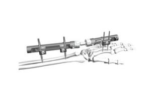 Wholesale Distal Radius External Fixation System Minimal Interference With Soft Tissue Cover from china suppliers