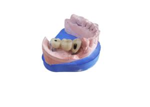China CAD CAM Zirconia Dental Crown With Titanium Base Zirconia Abutment on sale