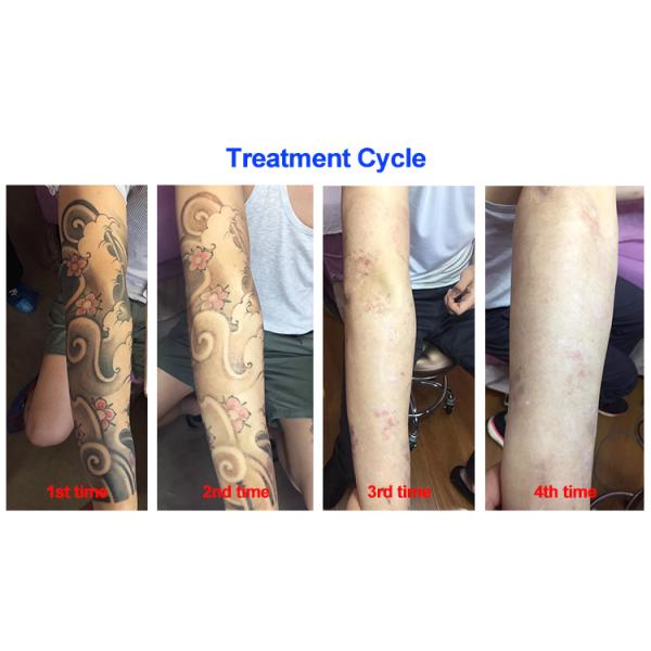 1500W Nd YAG Laser Tattoo Removal Machine 532nm 1064nm 1320nm