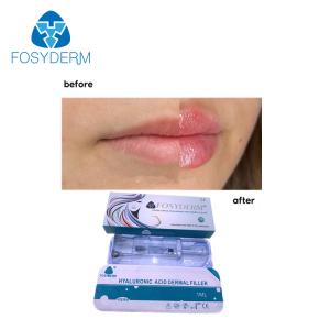 Wholesale Fosyderm Dermal Lip Fillers 1ml Hyaluronic Acid Injection For Lip Enhancement from china suppliers