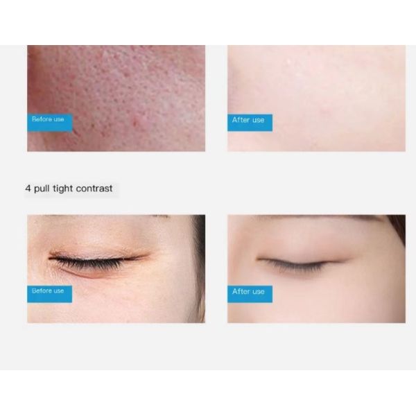 Blackhead Remover Hydra Beauty Machine Facial Skin Aqua Deep Cleaning 14 In 1