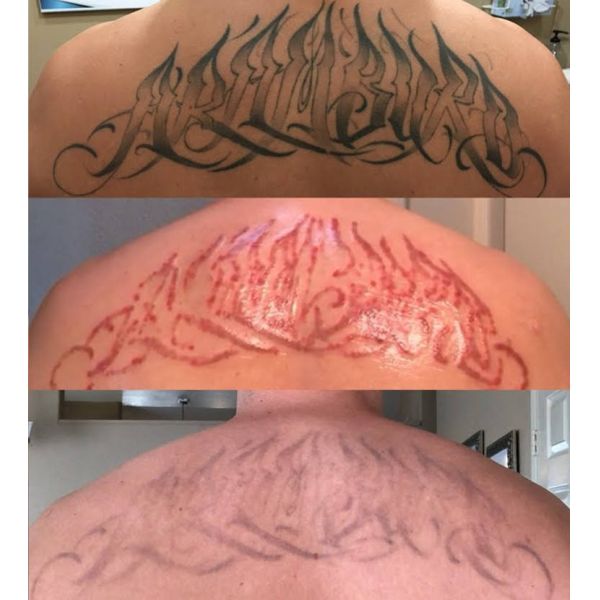 3 In 1 Q Switch ND Yag Laser Machine Tattoo Removal OEM ODM Services