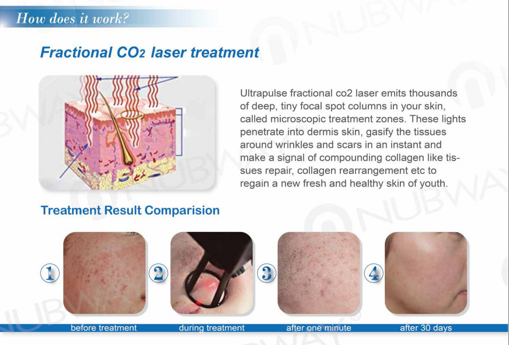 Portable fractional co2 laser device CO2 fractional laser machine with newest technolog