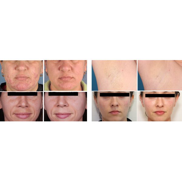 Professional Beauty Salon Device Hair Removal Q Switch Nd Yag Laser Beauty Machine