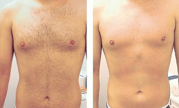 US Military Laser Bar Portable Laser Hair Removal Machines For Home Use