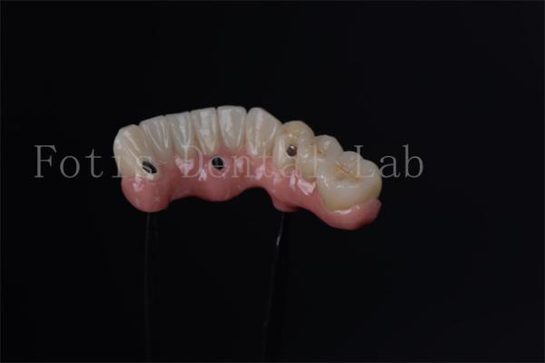 Quality Individual All On 4 All On 6 Endosteal Implants For Immediate Tooth Replacement for sale