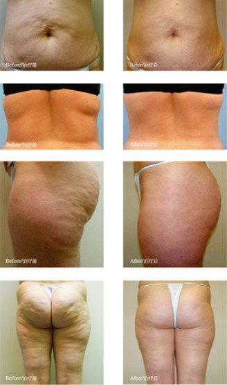 Vertical Cavitation Slimming Machine For Cellulite Reduction / Eye Wrinkle Removal